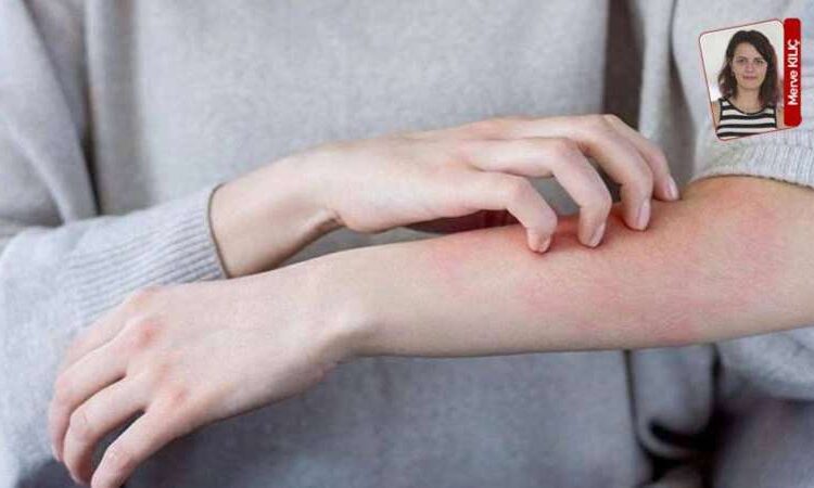 Uyuz alarmı: Krem ve losyonlar fayda etmiyor 1 Uyuz alarmı: Krem ve losyonlar fayda etmiyor