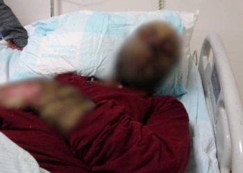 Milyonda 3 kişide görülen hastalık Türkiye’de: Yüzü tanınmaz hale geldi
