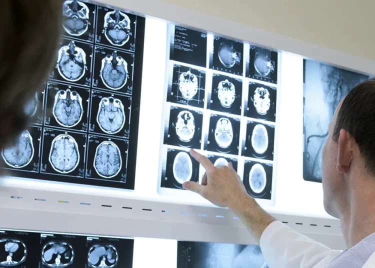Alzheimer’ı yavaşlatan ikinci ilaç ABD’de onay başvurusunda bulundu