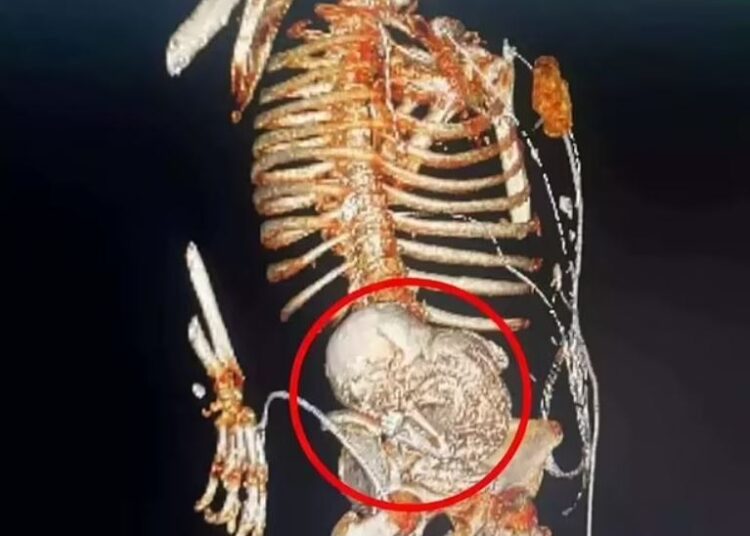 81 yaşındaki kadın 56 yıl karnındaki "taş bebek"le yaşamış 1 81 yaşındaki kadın 56 yıl karnındaki “taş bebek”le yaşamış