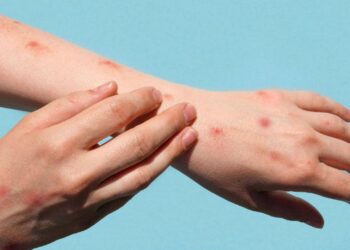 Maymun çiçeği virüsü Avrupa’ya sıçradı