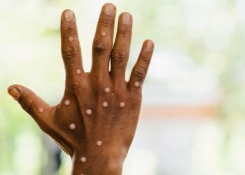 5 soruda Covid ile M çiçeği arasındaki farklar