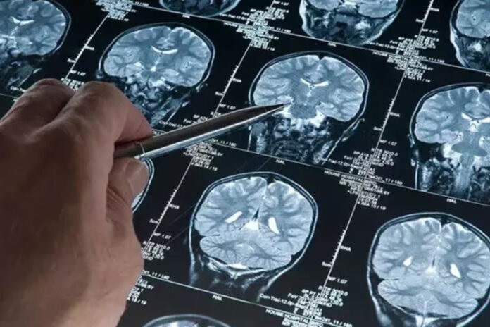 Alzheimer hastalığı artık erken tespit edilebilecek 1 Alzheimer hastalığı artık erken tespit edilebilecek